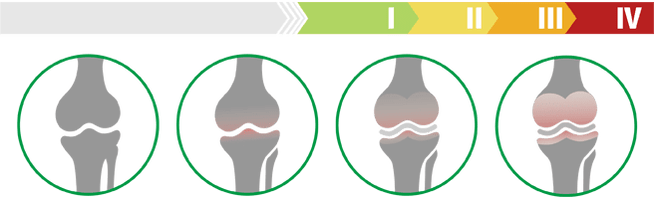 Stades cliniques de l'arthrose du genou (degré d'arthrose de l'articulation du genou)