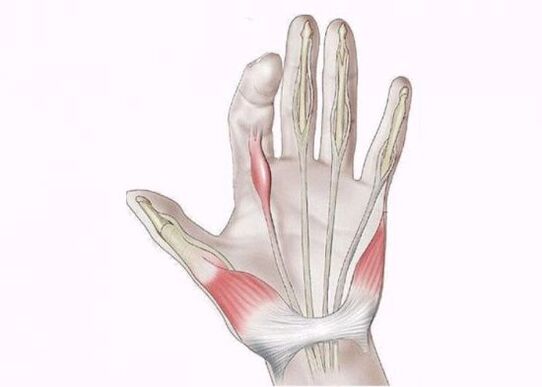 Inflammation des tendons comme cause de douleur dans les articulations des doigts