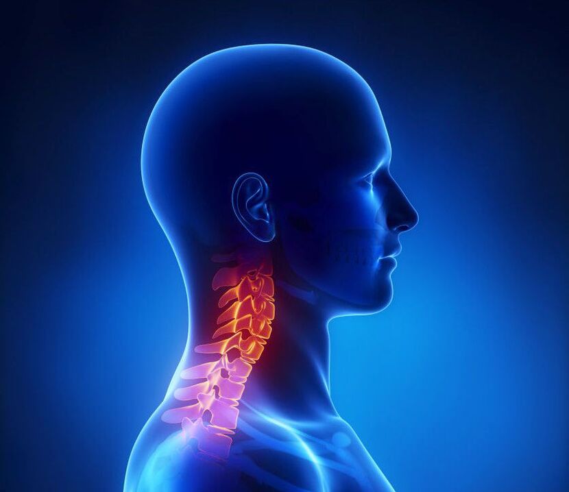 L'ostéochondrose cervicale est une pathologie de la colonne vertébrale dont vous pouvez vous débarrasser à la maison