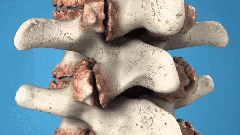Les ostéophytes de la colonne vertébrale comme cause de maux de dos