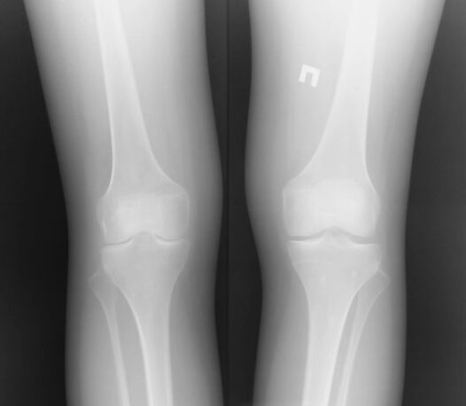 L'image x-ray de l'articulation du genou
