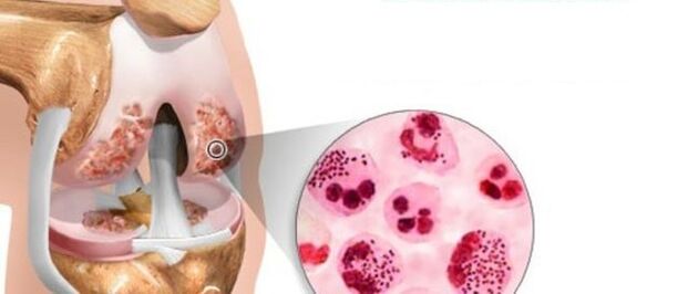 Cela conduit au développement de l'arthrose