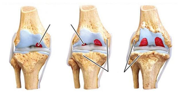 Complications de l'arthrose des articulations