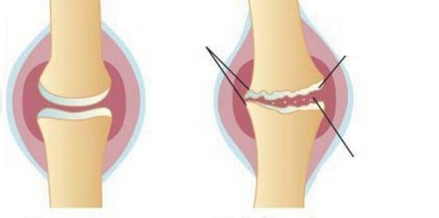 Laver le cartilage