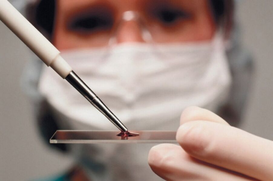 L'arthrite est une maladie inflammatoire dont la présence est déterminée par des analyses de sang.